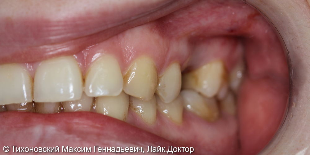 Имплантация в области отсутствующего 25 зуба - фото №1