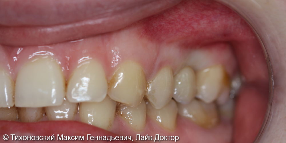 Имплантация в области отсутствующего 25 зуба - фото №2