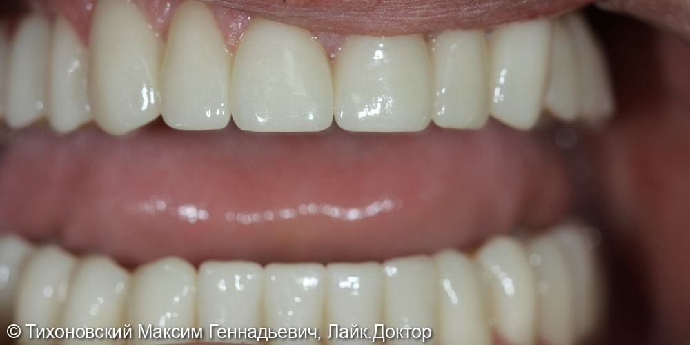 Тотальное протезирование на имплантах и своих зубах - фото №1