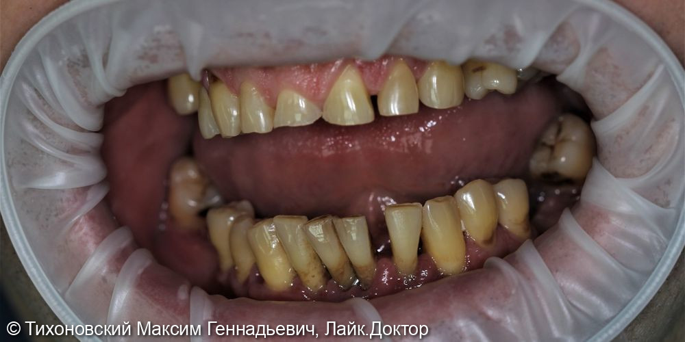 Тотальное протезирование на имплантах и своих зубах - фото №3