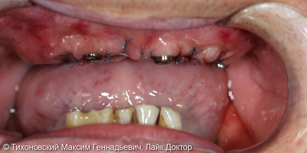 Операция All-on-4 или зубы за 1 день - фото №1