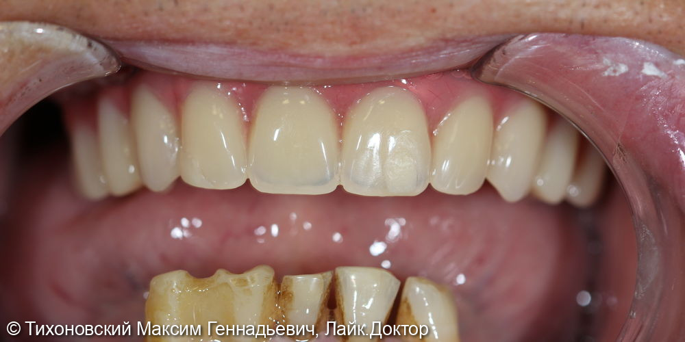 Операция All-on-4 или зубы за 1 день - фото №2