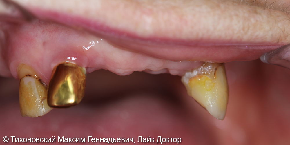 Тотальное протезирование верхней челюсти на имплантах и своих зубах - фото №1