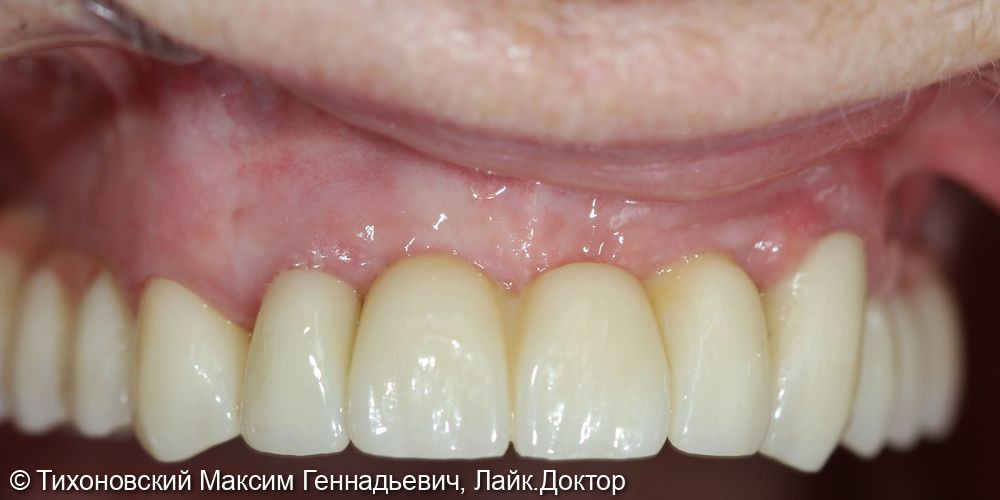Тотальное протезирование верхней челюсти на имплантах и своих зубах - фото №2