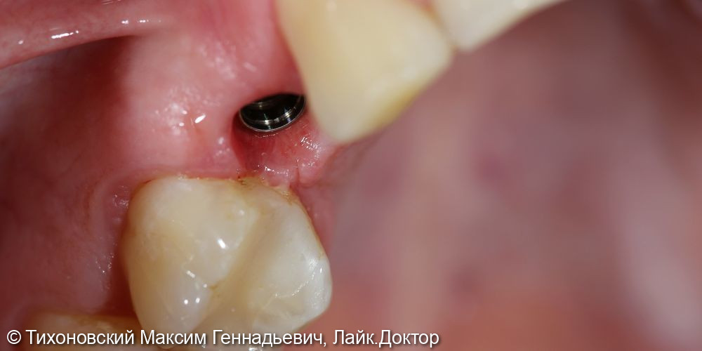 Замещение утраченного зуба имплантатом Straumann - фото №1