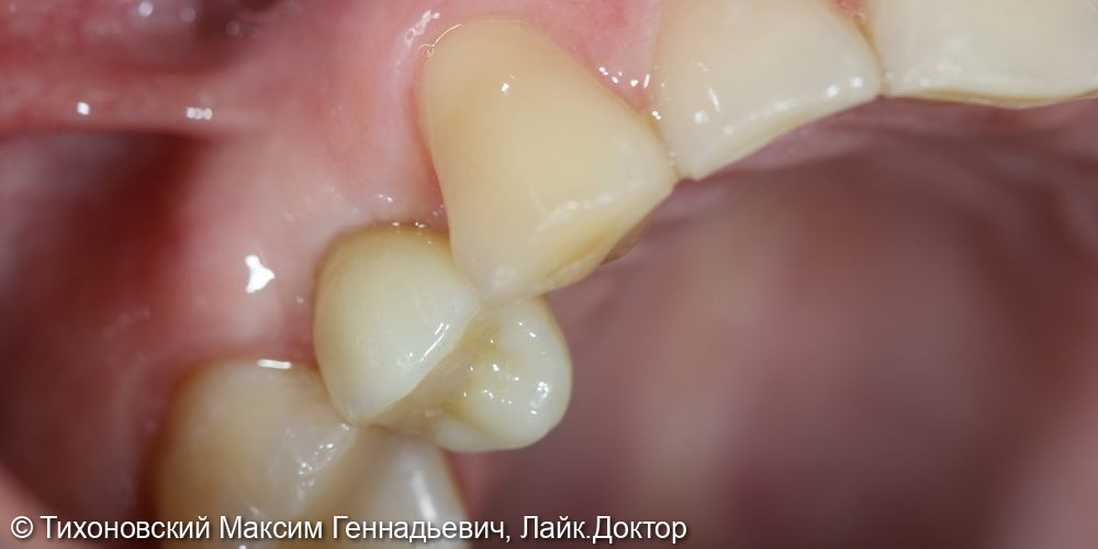 Замещение утраченного зуба имплантатом Straumann - фото №2
