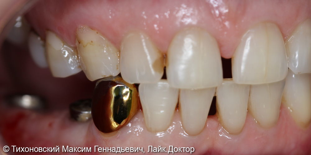 Замещение участка утраченных зубов имплантами и замена коронки - фото №1