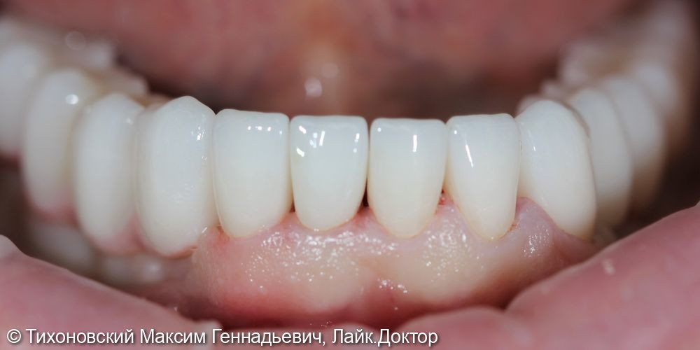 Тотальная работа на нижней челюсти с использованием имплантов и коронок на свои зубы - фото №1