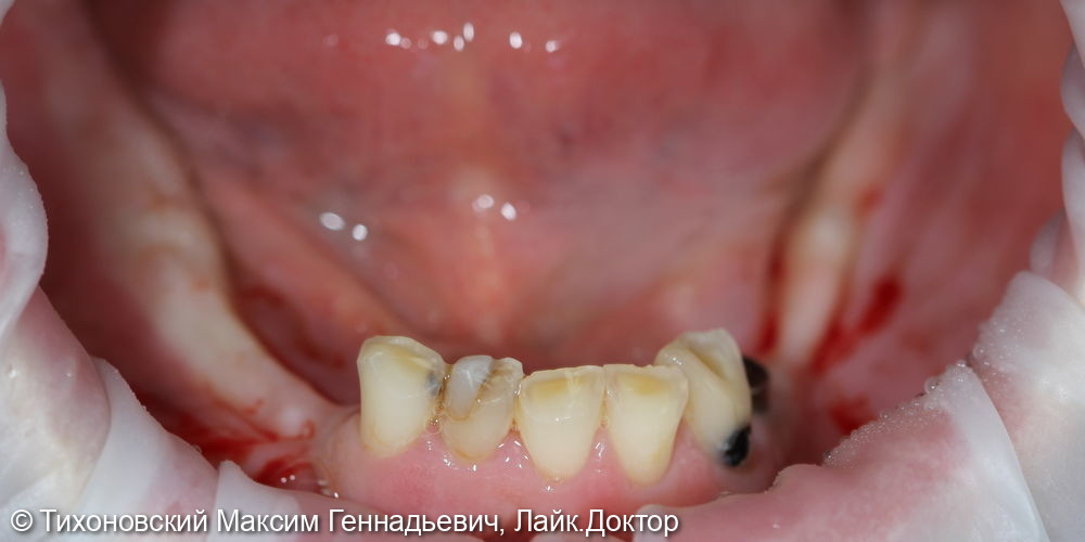 Тотальная работа на нижней челюсти с использованием имплантов и коронок на свои зубы - фото №2