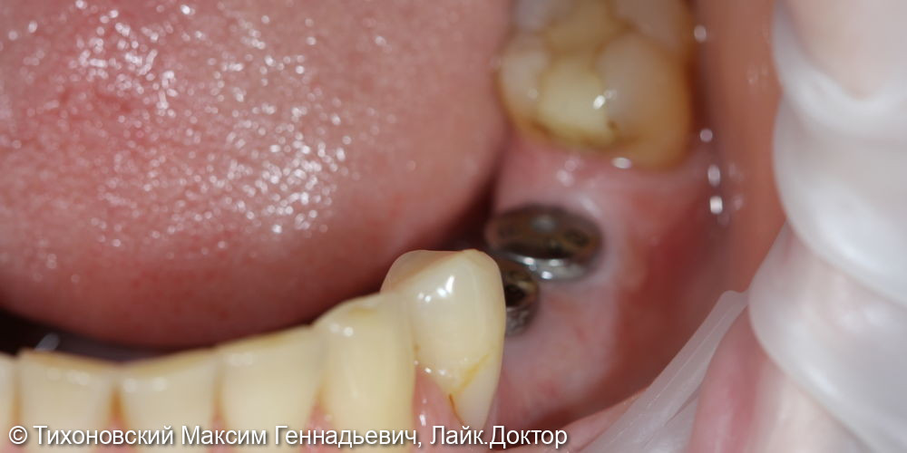 Замещение утраченных зубов на нижней челюсти имплантами и коронками из диоксида циркония - фото №1