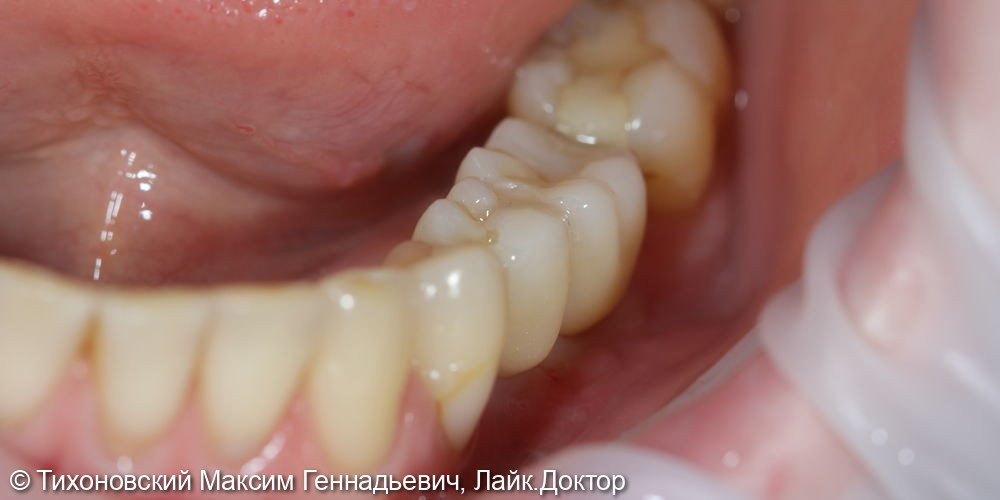 Замещение утраченных зубов на нижней челюсти имплантами и коронками из диоксида циркония - фото №2