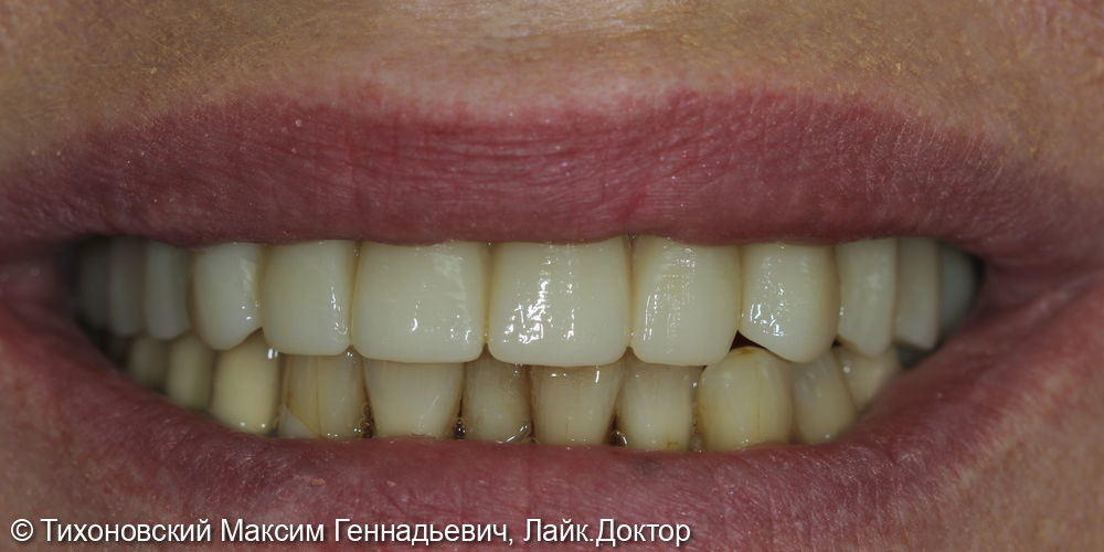 тотальное протезирование верхней челюсти на имплантах Straumann - фото №2