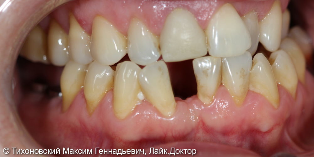 Установка имплантата и коронки из ZnO2 в область утраченного переднего резца нижней челюсти - фото №1