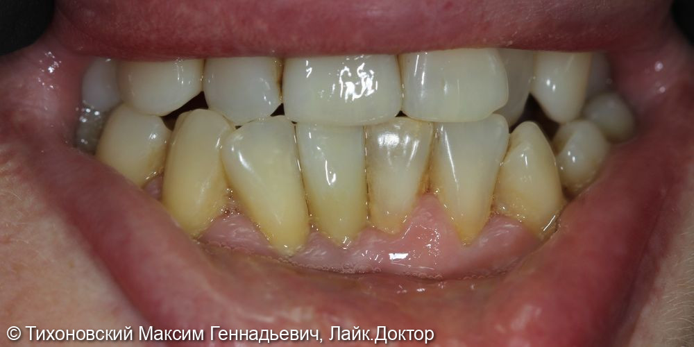 Установка имплантата и коронки из ZnO2 в область утраченного переднего резца нижней челюсти - фото №3