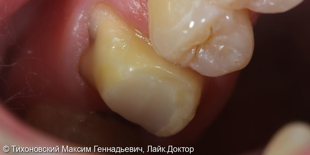 Установка коронки из ZrO2 на свой зуб - фото №1