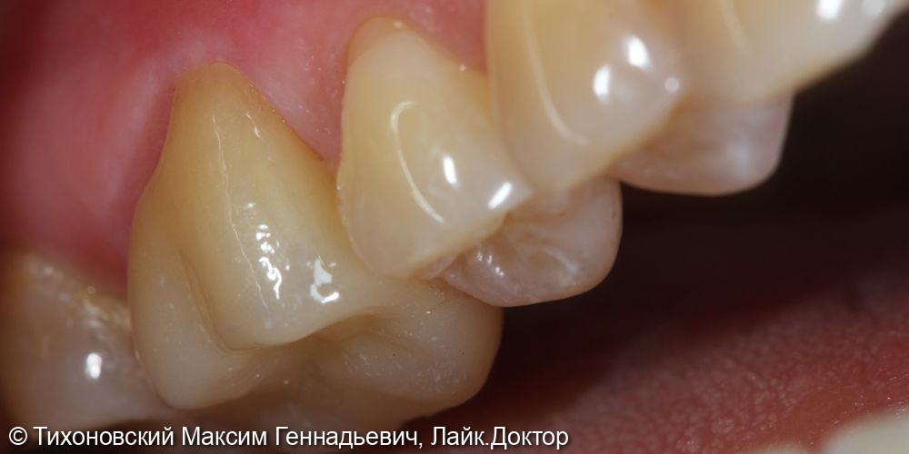 Установка коронки из ZrO2 на свой зуб - фото №2