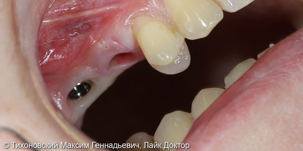 Установка имплантов Straumenn и коронок из ZrO2 на место ранее удаленных зубов - фото №1