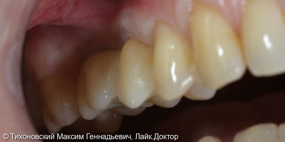 Установка имплантов Straumenn и коронок из ZrO2 на место ранее удаленных зубов - фото №2