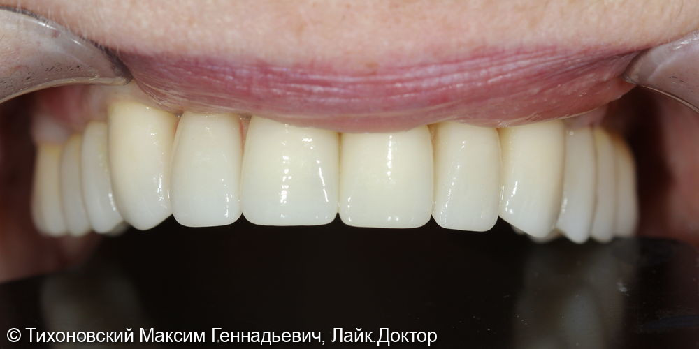 Тотальная реабилитация пациентки с отсутствием зубов - фото №2