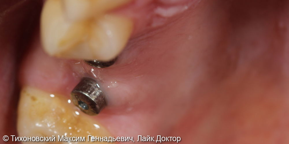восстановление утраченных зубов имплантами - фото №1