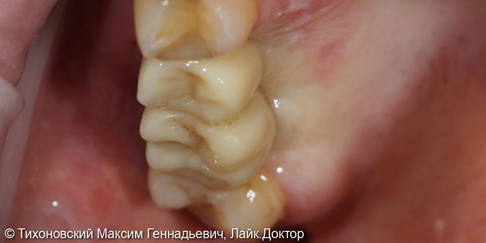 восстановление утраченных зубов имплантами - фото №2