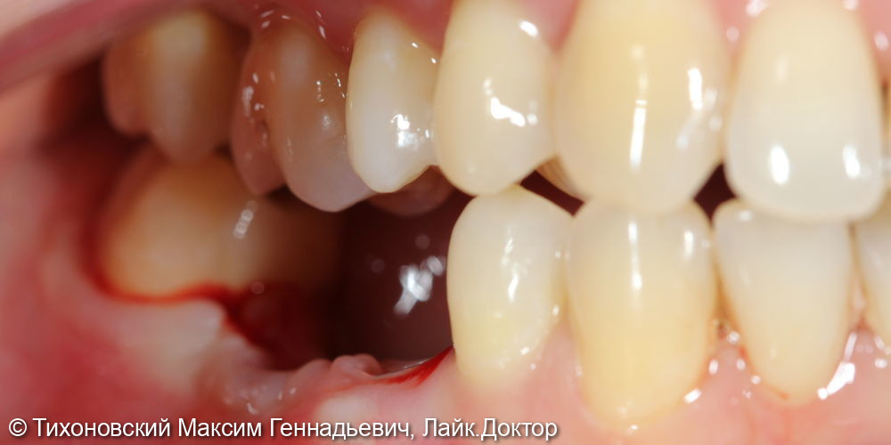 Восстановление утраченных зубов с использованием имплантатов - фото №1