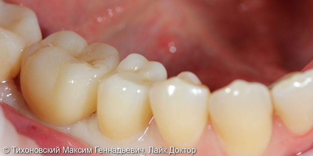 Восстановление утраченных зубов с использованием имплантатов - фото №2