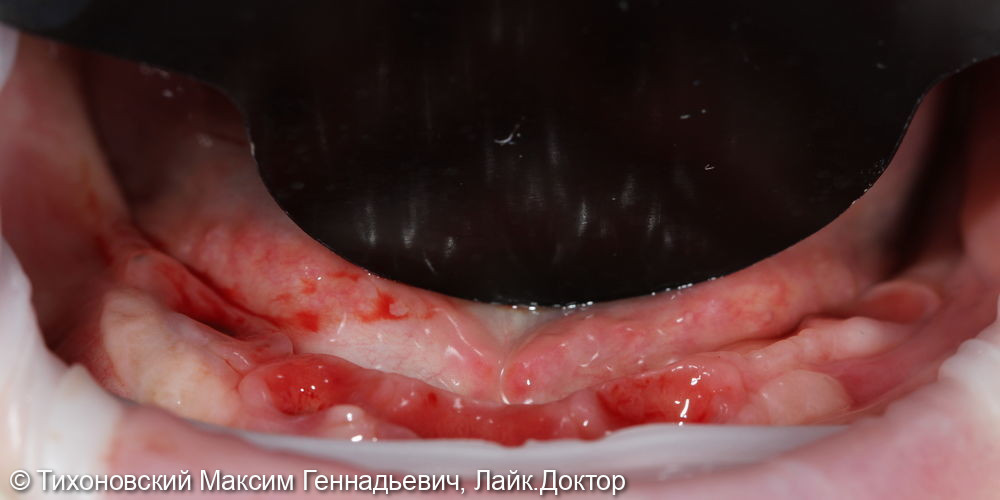 замещение утраченных зубов на нижней челюсти имплантами и протезом из ZrO2 - фото №1