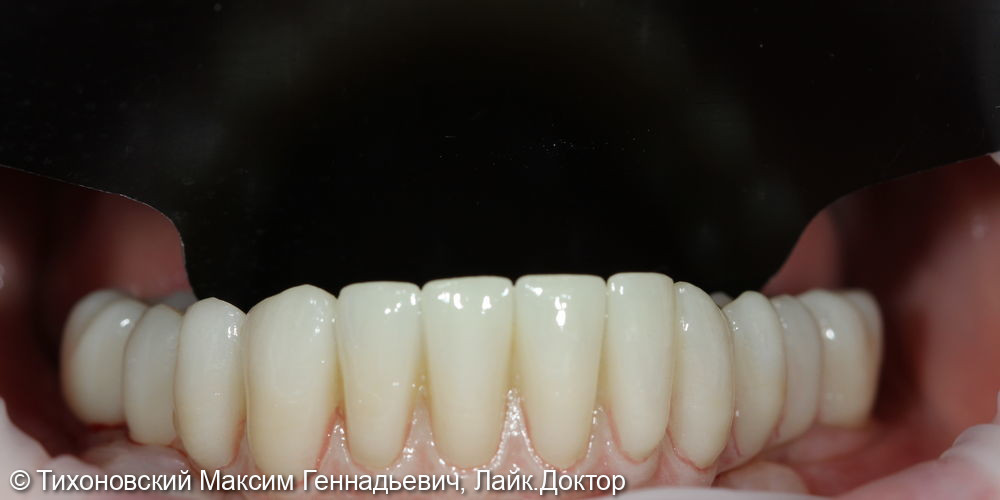 замещение утраченных зубов на нижней челюсти имплантами и протезом из ZrO2 - фото №2