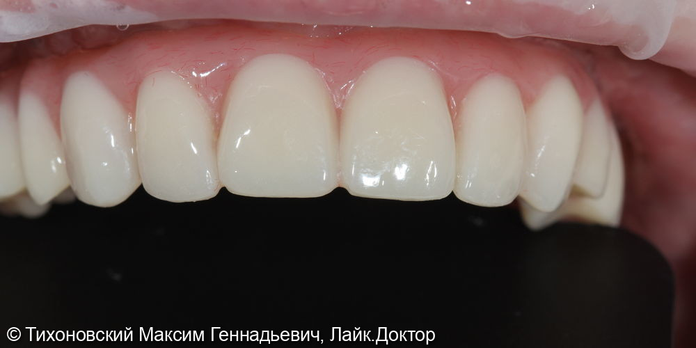 замещение утраченных зубов пластмассовым протезом с акриловыми зубами на 4-х имплантатах - фото №2