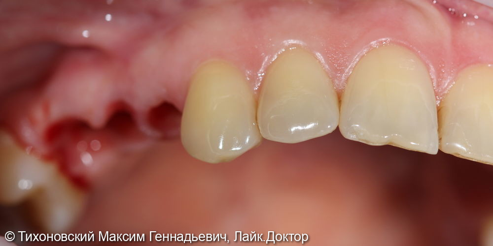 Замещение утраченных зубов с помощью имплантатов - фото №1