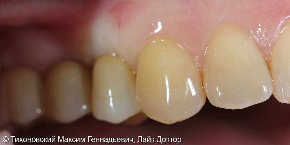Замещение утраченных зубов с помощью имплантатов - фото №2