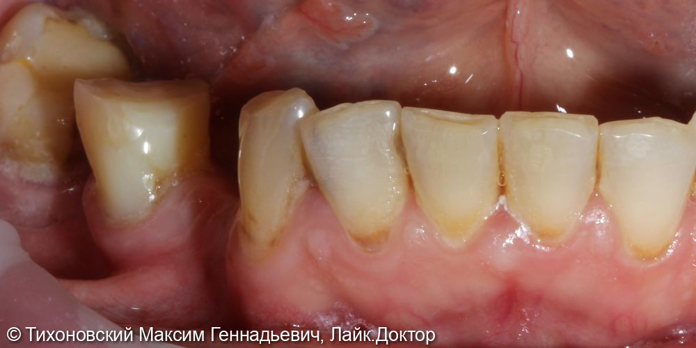 Восстановление утраченных зубов в боковом отделе нижней челюсти справа - фото №1