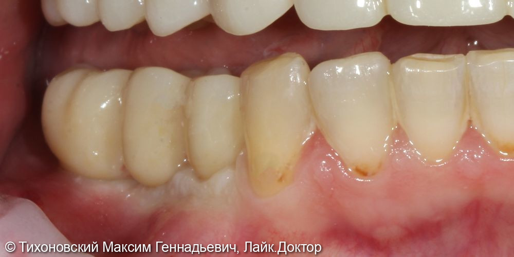 Восстановление утраченных зубов в боковом отделе нижней челюсти справа - фото №2