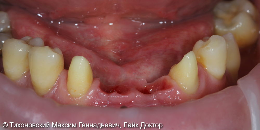 Восстановление утраченных зубов с помощью имплантов и коронок из диоксида ZrO2 - фото №1