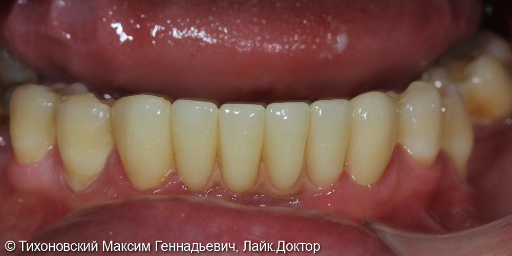 Восстановление утраченных зубов с помощью имплантов и коронок из диоксида ZrO2 - фото №2