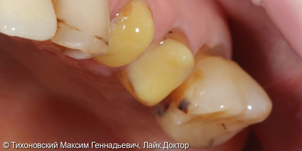 Одномоментная имплантация с закрытым синус-лифтингом в области несостоятельных зубов и Протезирование коронками из ZrO2 - фото №1