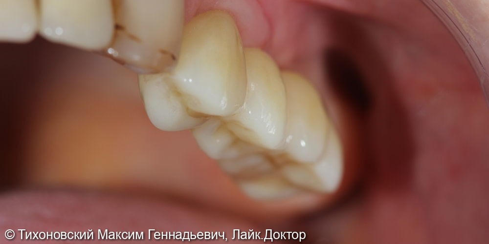 Одномоментная имплантация с закрытым синус-лифтингом в области несостоятельных зубов и Протезирование коронками из ZrO2 - фото №2