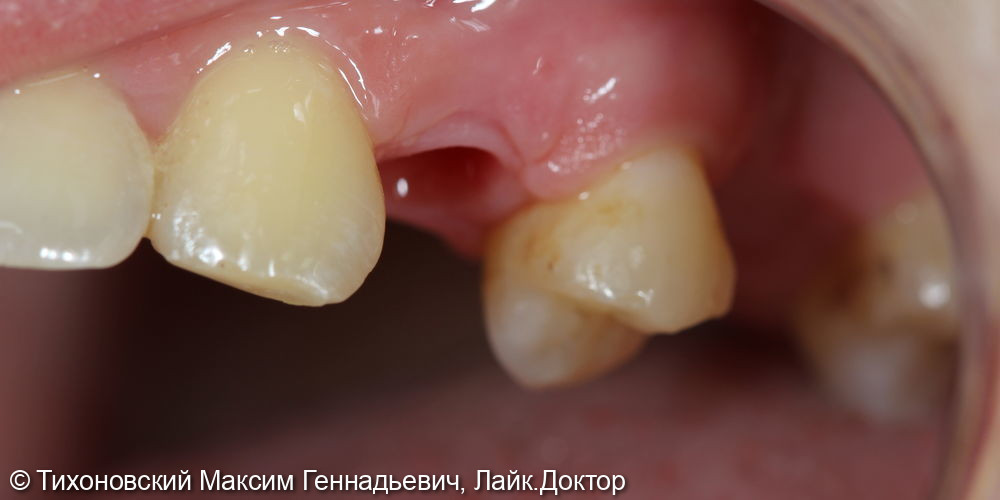 Замена утраченного 24 зуба с помощью имплантата - фото №1