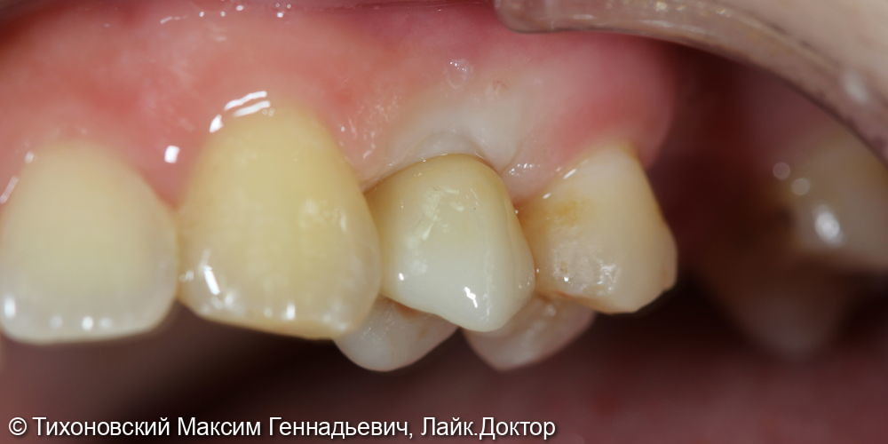 Замена утраченного 24 зуба с помощью имплантата - фото №2