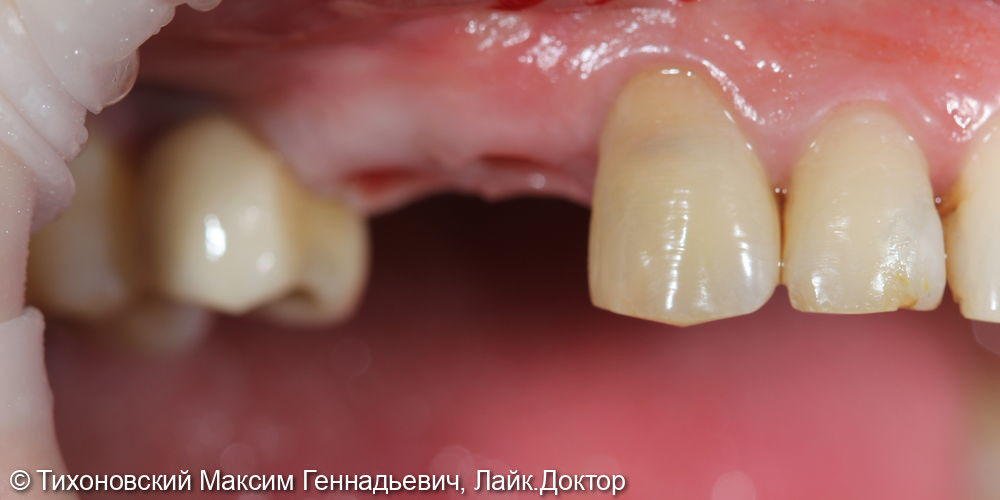 Установка 2-х имплантов и протезирование коронками из ZrO2 в области ранее удаленных зубов - фото №1