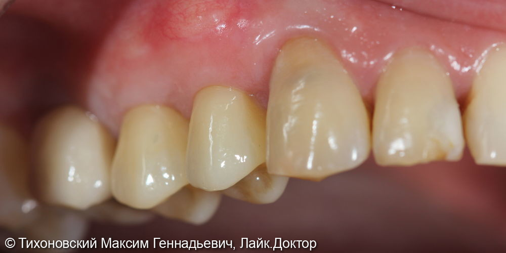 Установка 2-х имплантов и протезирование коронками из ZrO2 в области ранее удаленных зубов - фото №2