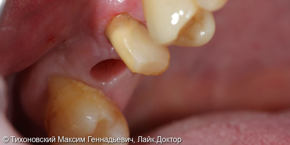 Замещение утраченного зуба имплантом и установка коронки из ZrO2 на свой зуб - фото №1