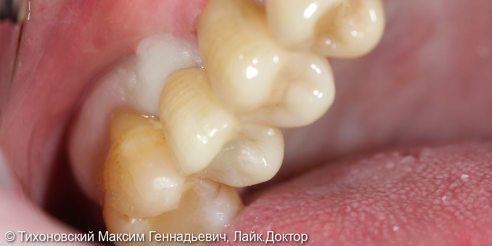 Замещение утраченного зуба имплантом и установка коронки из ZrO2 на свой зуб - фото №2