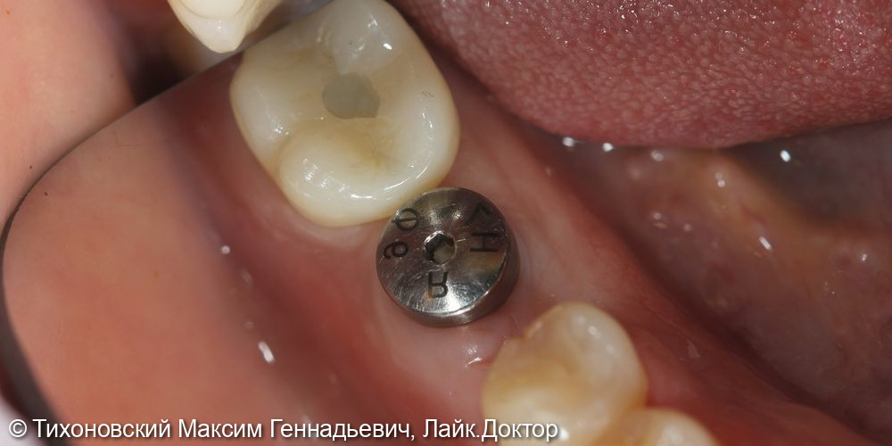 Замещение утраченного зуба имплантом и коронкой из диоксида циркония - фото №1