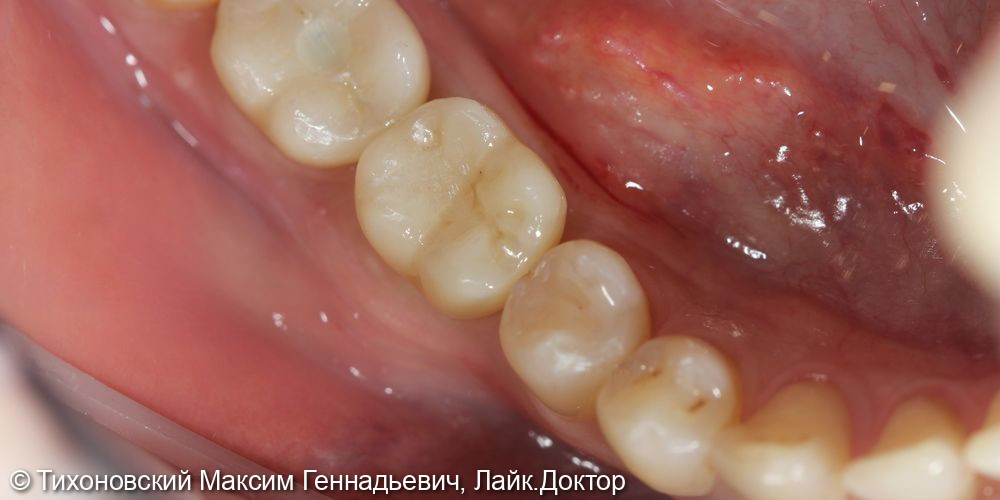 Замещение утраченного зуба имплантом и коронкой из диоксида циркония - фото №2