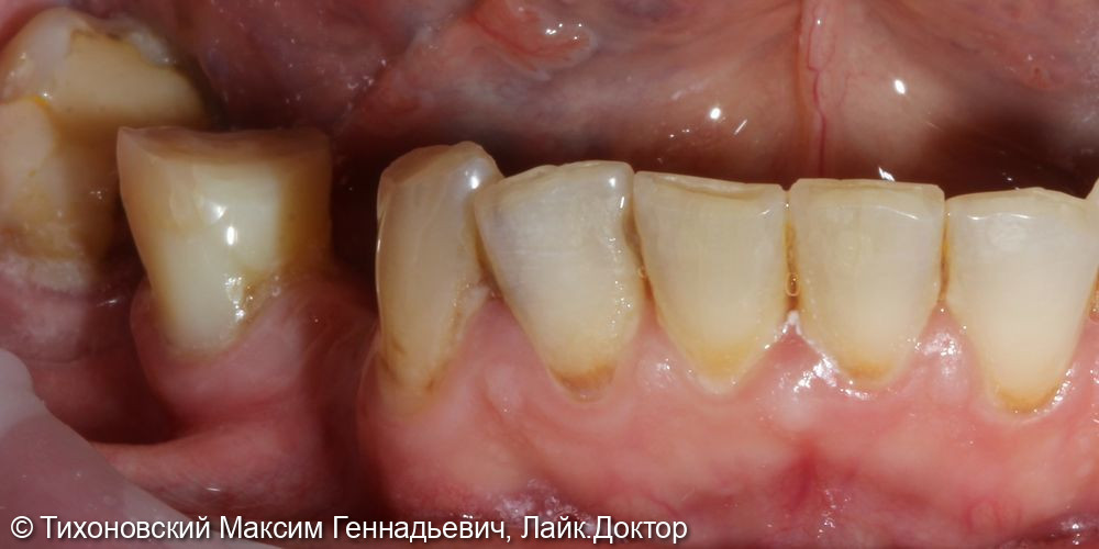 Установка имплантатов с мягкотканной пластикой в области ранее удаленных зубов - фото №1