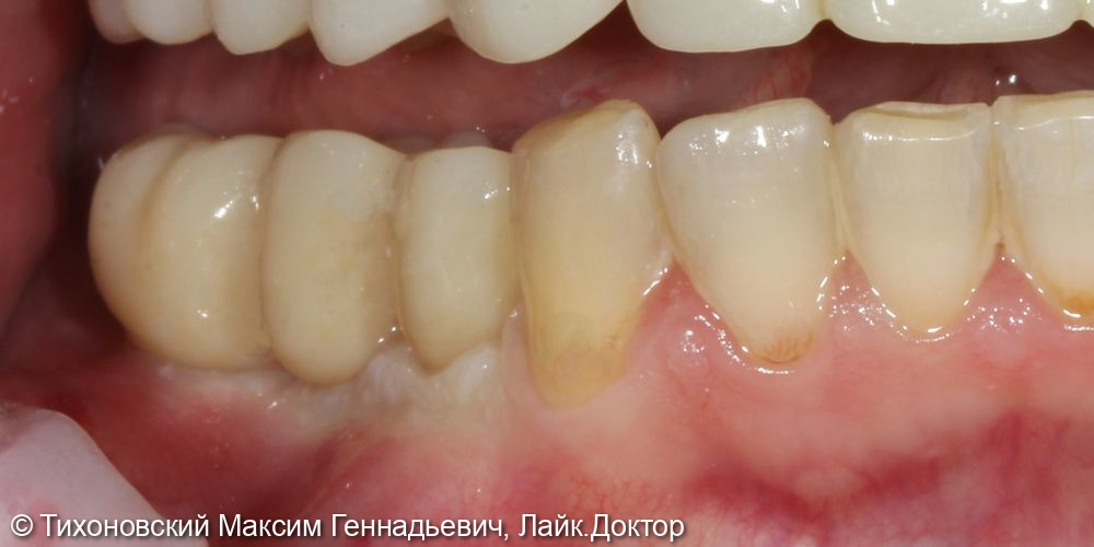 Установка имплантатов с мягкотканной пластикой в области ранее удаленных зубов - фото №2
