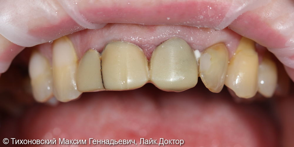 Восстановление эстетики и замещение ранее утраченного 12 зуба с помощью импланта и коронок из ZrO2 - фото №1