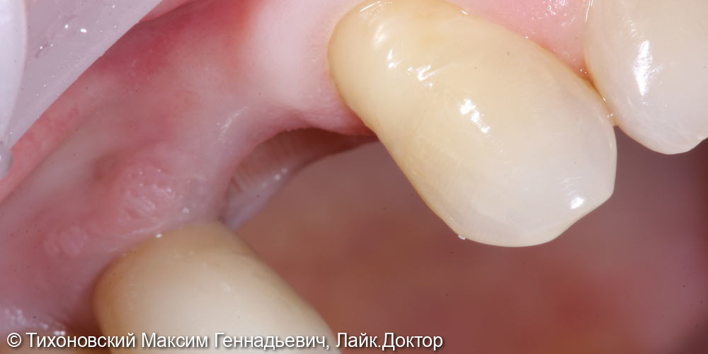 Восстановление утраченного зуба имплантатом и коронкой из ZrO2 - фото №1